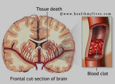 sobre el accidente cerebrovascular