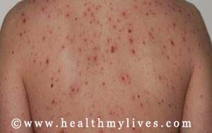 syphilis ikatlong yugto