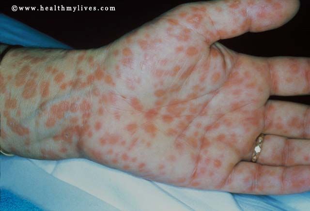 syphilis ikalawang yugto