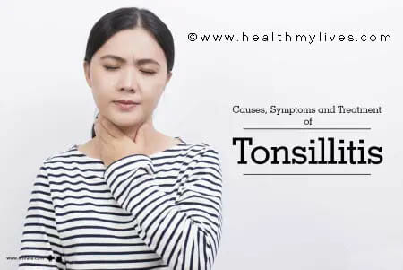 Tonsillitis causes symptoms and treatment
