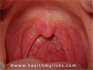 causas faringitis