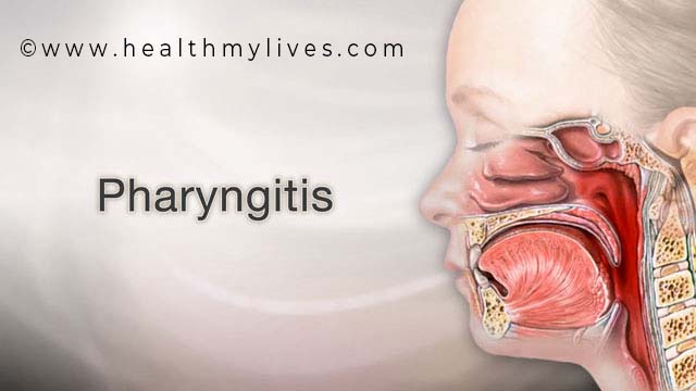 pharyngitis
