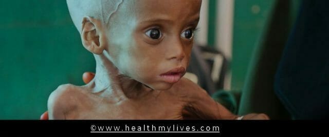 Malnourished Child