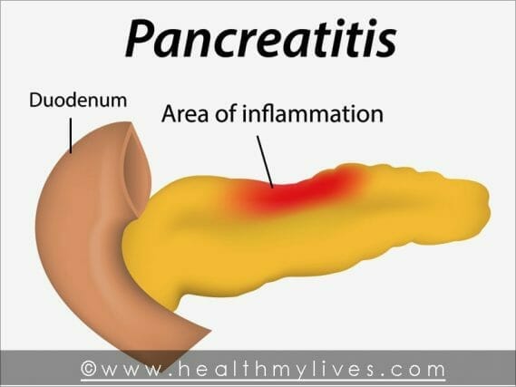 Penyebab Pankreatitis