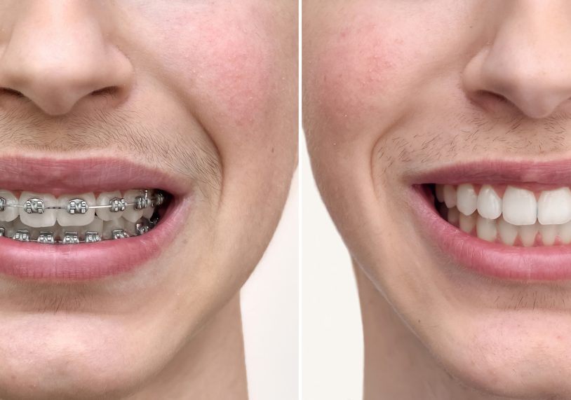 Teeth of a teenage boy before and after dental braces treatment. Close-up. Health care and medical concept.